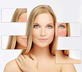 IPL Treatment for Rosacea in Crabtree Valley - Raleigh, NC